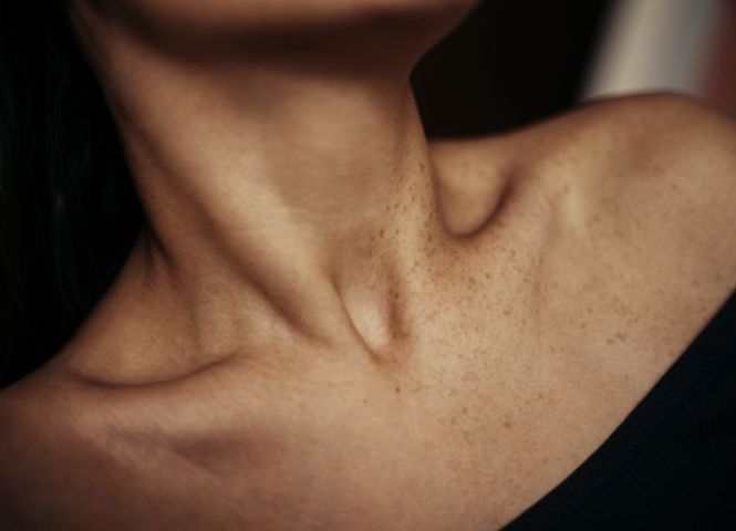 Comment traiter le cou et le décolleté avec les injections